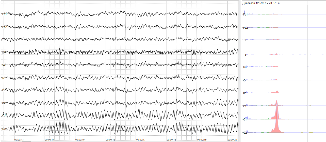 Le neurofeedback et le TDAH : que dit vraiment la recherche ?