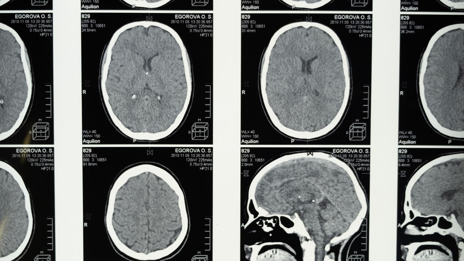 Coupes d'IRM cérébrale montrant l'anatomie du cerveau
