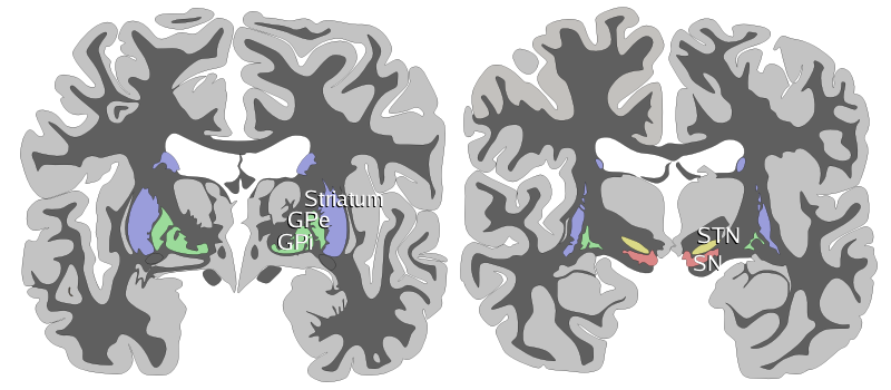 La maladie de Huntington : au-delà des mouvements, la cognition